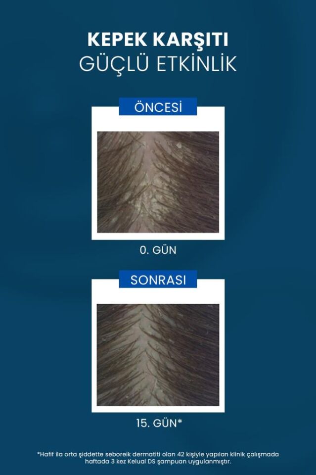 Ducray Kelual DS Shampoo 100ml